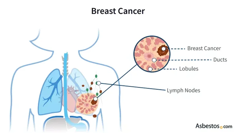 Breast cancer diagram explanation
